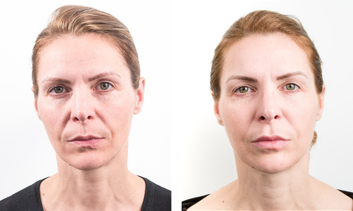 face lifting treatment